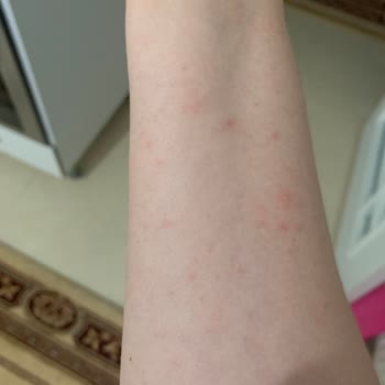 Mustela Güneş Kremi Alerji