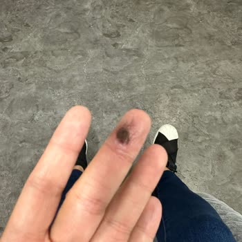 Rowenta Protect Saç Kurutma Makinesi Elimde Patladı!