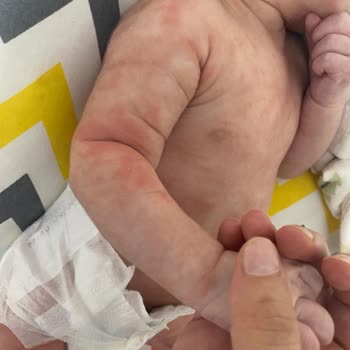 Mustela Şampuan Seti Bebeğimde Egzamaya Sebep Oldu