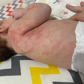 Mustela Şampuan Seti Bebeğimde Egzamaya Sebep Oldu