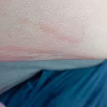 Tülin Çetin Profesyonel Kalıcı Makyaj & Kaş Tasarım Lazer Epilasyon Deneyimi Ve Yanık Şikayeti