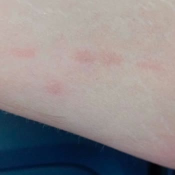 Tülin Çetin Profesyonel Kalıcı Makyaj & Kaş Tasarım Lazer Epilasyon Deneyimi Ve Yanık Şikayeti