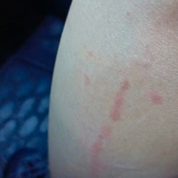 Tülin Çetin Profesyonel Kalıcı Makyaj & Kaş Tasarım Lazer Epilasyon Deneyimi Ve Yanık Şikayeti