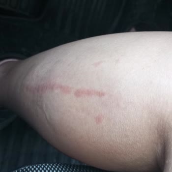 Tülin Çetin Profesyonel Kalıcı Makyaj & Kaş Tasarım Lazer Epilasyon Deneyimi Ve Yanık Şikayeti