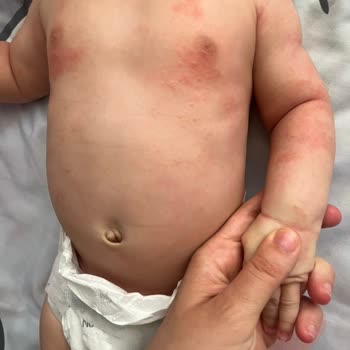 Mustela Pişmanlıktır Egzamaya Sebep Oldu