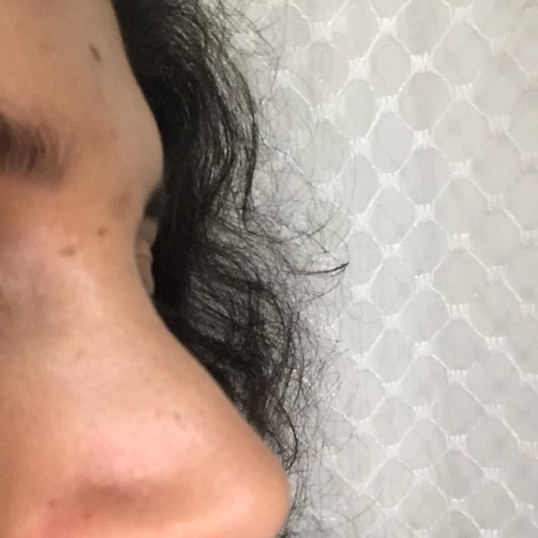 Doç. Dr. Tolga Kırgezen Burun Estetiği Sonrası Herkesin Dalga Geçtiği Bir Buruna Sahip Oldum!