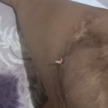 Adana Şehir Hastanesi Doktor Sorumsuzluğu Kolda Gazlı Bez Unutuldu