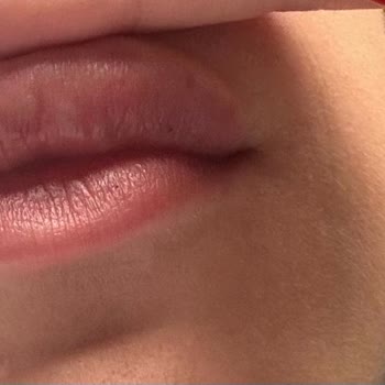 British Esthetic Dudak Dolgusu İşleminde Hayal Kırıklığı