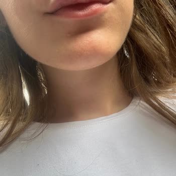 British Esthetic Dudak Dolgusu İşleminde Hayal Kırıklığı