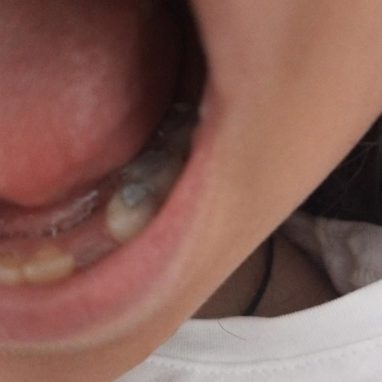 Dr. Behçet Uz Çocuk Hastalıkları ve Cerrahisi Eğitim ve Araştırma Hastanesi Diş Dolgusu İçin Yapılan Müdahalenin Çok Kötü Olması