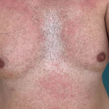 Siveno Güneş Losyon Alerji