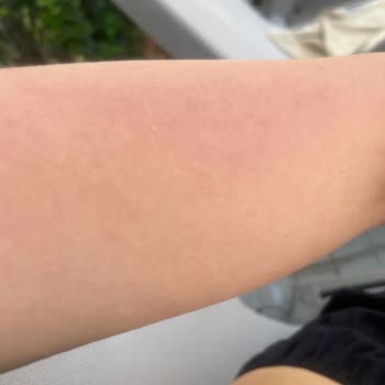 Siveno Güneş Losyon Alerji