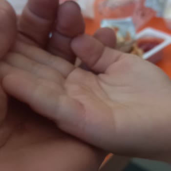 Burger King Ödeme Bankosunun Elektrik Kablosu Kızımın Elini Yaktı.