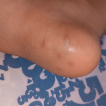 Side Win Hotel & Spa Zehirlenme Ve Enfeksiyon Oteli Side Win Hotel SPA