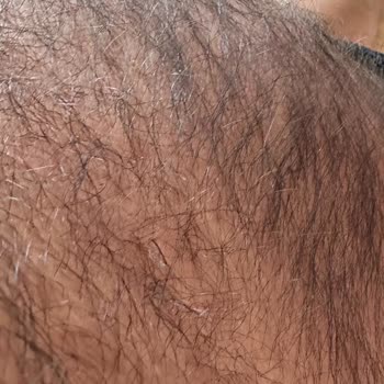 Epiyes Estetik Tahsilatçı Lazer Markası