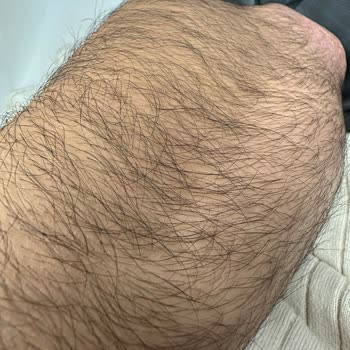 Epiyes Estetik Tahsilatçı Lazer Markası