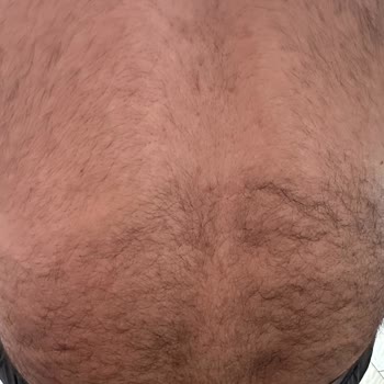 Epiyes Estetik Tahsilatçı Lazer Markası