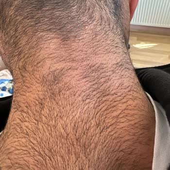 Epiyes Estetik Tahsilatçı Lazer Markası