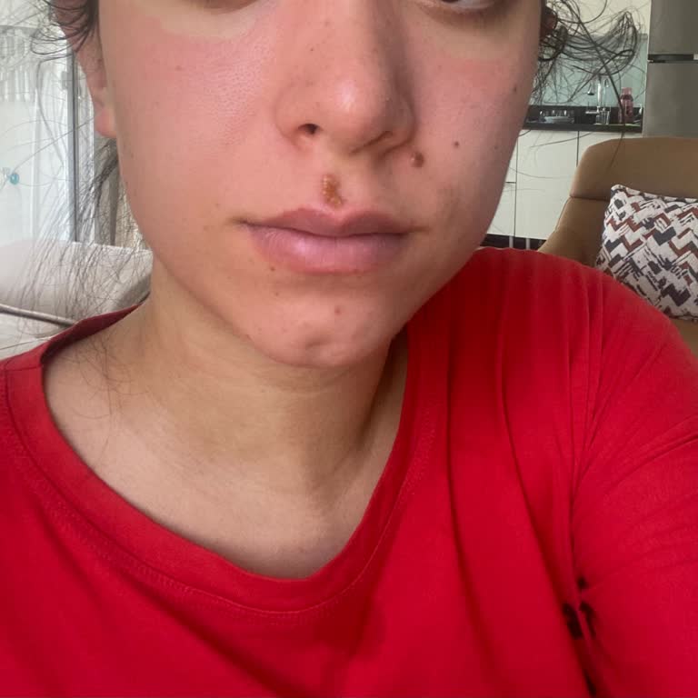 Yves Rocher İlk Yıkamada Yüzüm Yandı