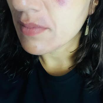 Venom Güzellik Salonu Uygulaması Sonrası Kalıcı Cilt Lekesi