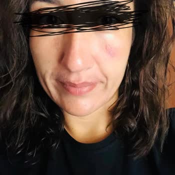 Venom Güzellik Salonu Uygulaması Sonrası Kalıcı Cilt Lekesi