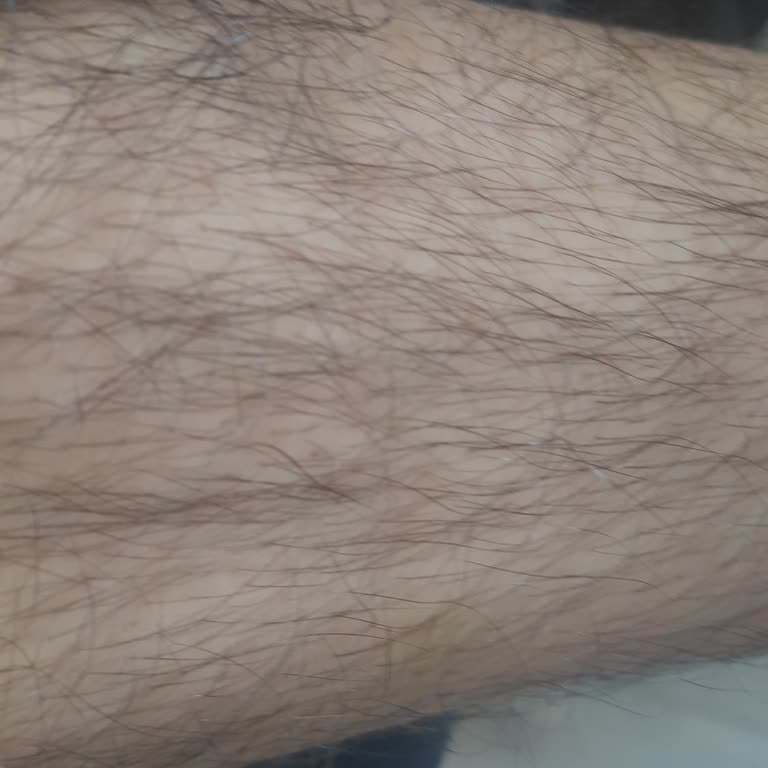 Smokin Lazer Epilasyon Şikayeti:etkisiz Ve Gereksiz