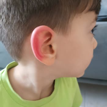 Argivit Focus Alerjik Reaksiyon