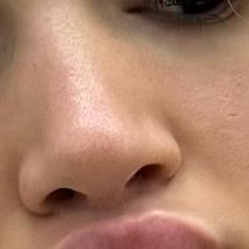 Privacy Estetik Burun Revizyonu Şikayeti