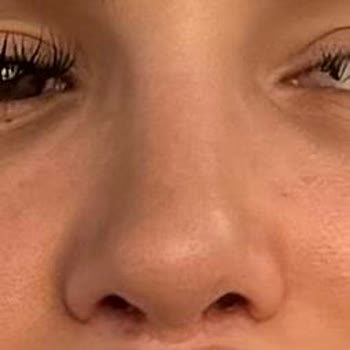 Privacy Estetik Burun Revizyonu Şikayeti