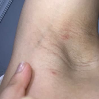 Rexona Clinical Skandalı Kist Oluştu