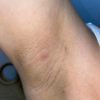 Rexona Clinical Skandalı Kist Oluştu