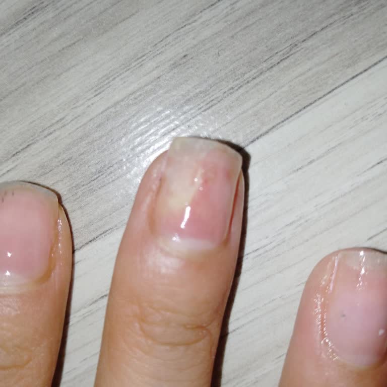 Purple Beauty Tırnak Mantarı Oldum