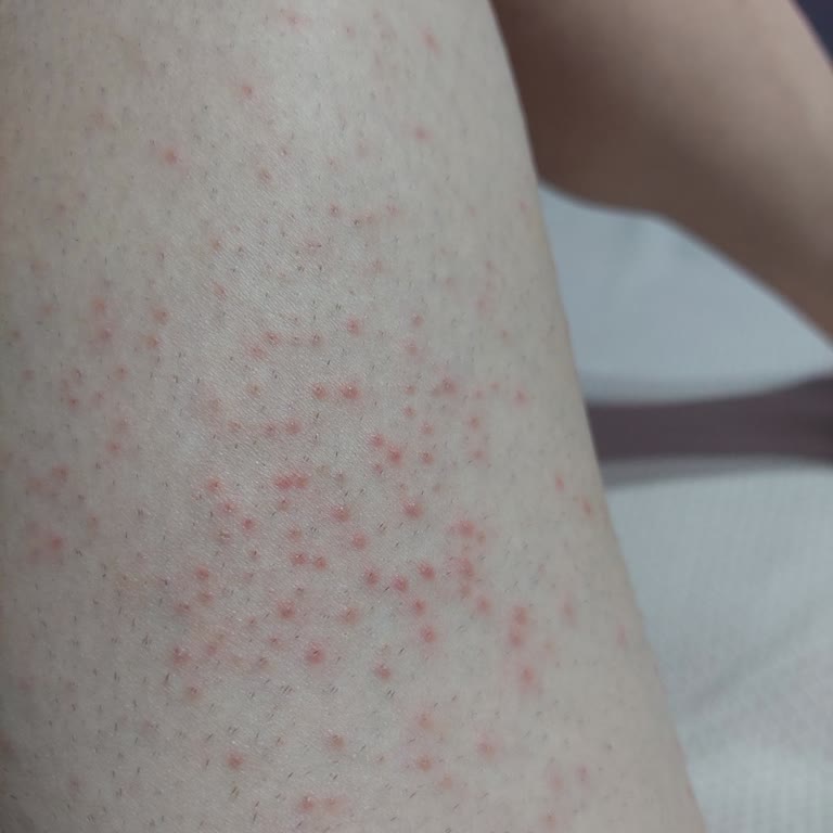 Veet Tüy Dokucu Krem Yanığı