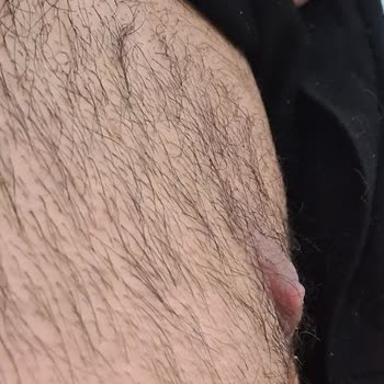 Doç. Dr. Yahya Baltu Jinekomasti Ameliyatı Ve Göğüs Ucunda Deformasyon