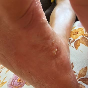 Crocs Terlik Ayakları Yara Yapıyor
