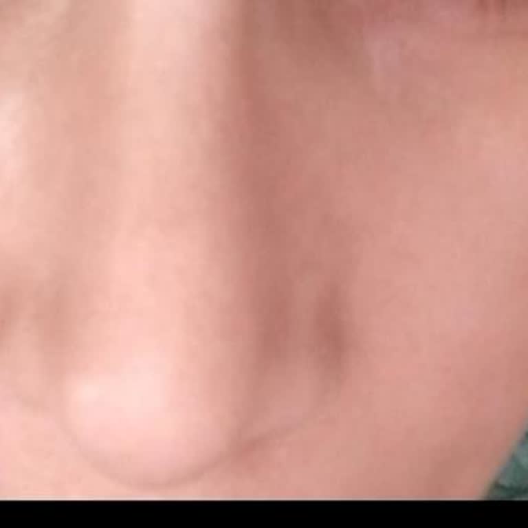 Buhara Hastanesi Burun Estetiği Sonucum Hayatım Karardı