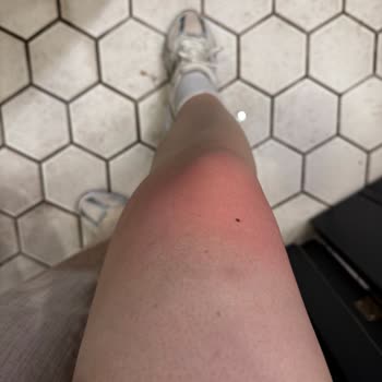 Qubish Chocolate Cafe'de Üstüme Kaynar Çay Döktüler!