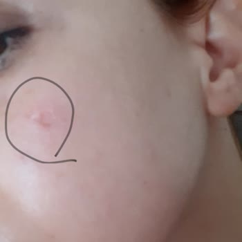 Enza Güzellik Merkezleri Yüzüm Yandı PRP İşlem