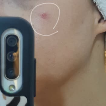 Enza Güzellik Merkezleri Yüzüm Yandı PRP İşlem