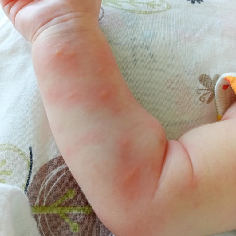 Sma Optipro 1 Alerji Yapıyor