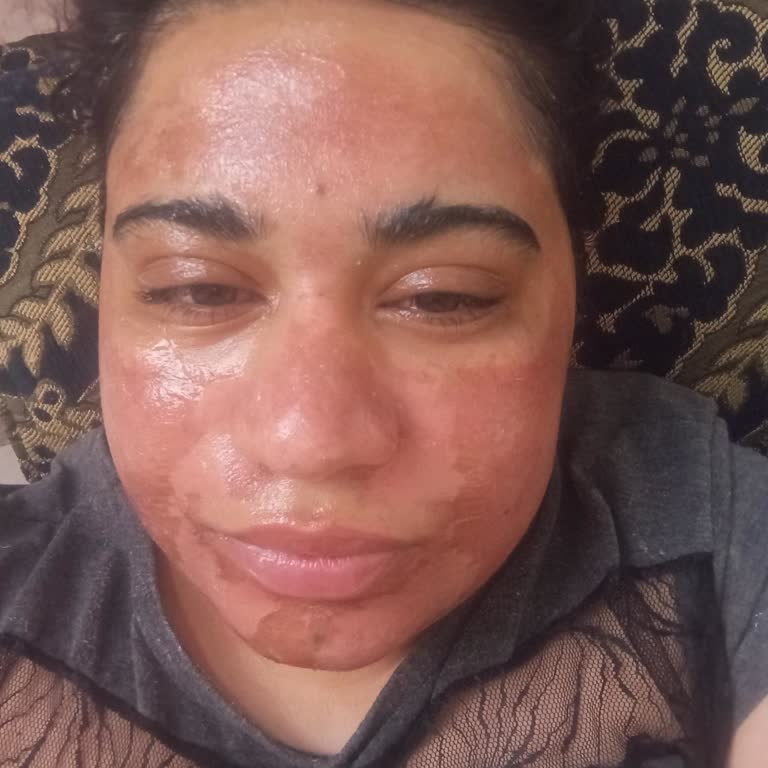 Rönesans Vip Güzellik Salonu Yosun Peeling Yaptırdım Yüzüm Yandı Hala Düzelmedi