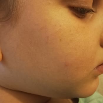 Bioderma Güneş Kremi Sivilce Yaptı