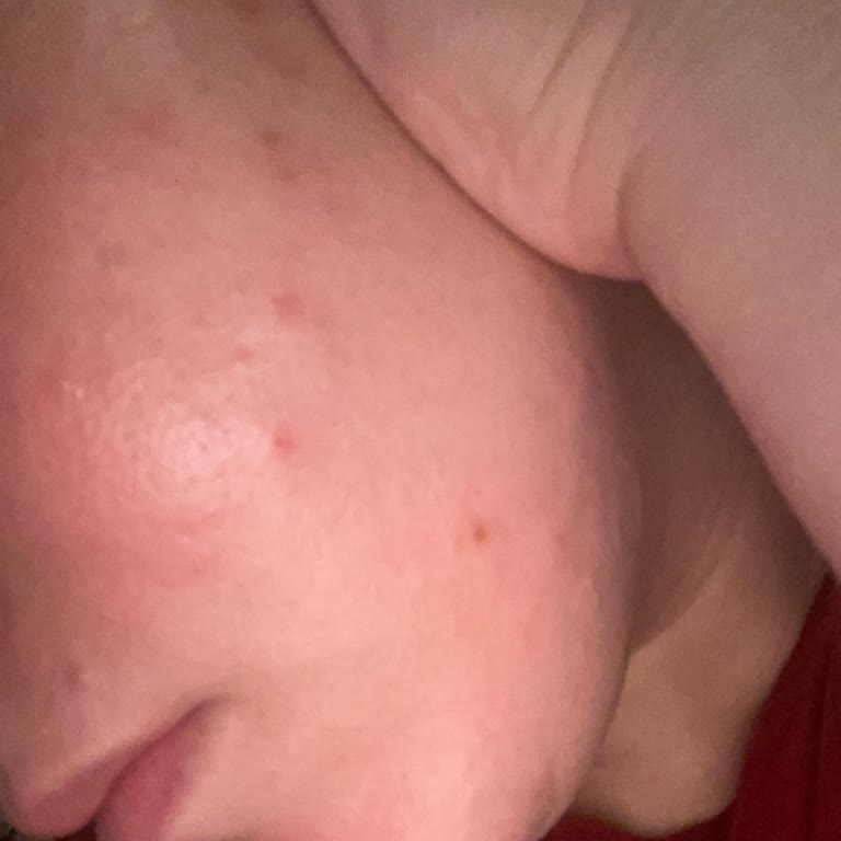 Hada Labo Tokyo SPF 50 Güneş Kremi Sonrası Cilt Sorunları