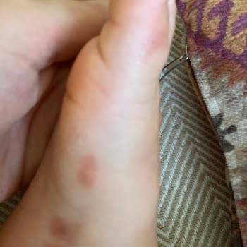 Vicco Ayakkabı Yara Yaptı