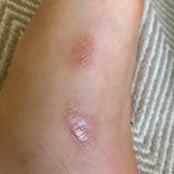 Vicco Ayakkabı Yara Yaptı