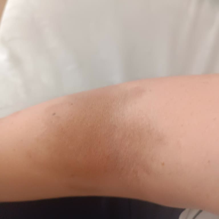 Sultan 2.Abdülhamid Han Eğitim ve Araştırma Hastanesi Morluk Oluştu Serumdan Sonra