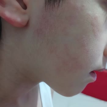 Duru Sabun Duru Marka Alerji Yaptı Cilt Döküntüsü Yaptı