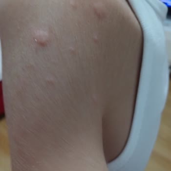 Duru Sabun Duru Marka Alerji Yaptı Cilt Döküntüsü Yaptı