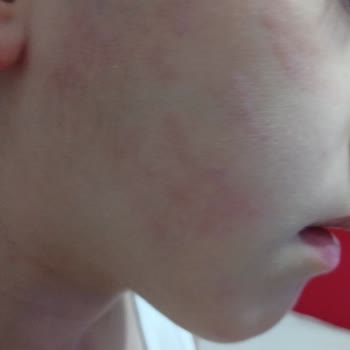 Duru Sabun Duru Marka Alerji Yaptı Cilt Döküntüsü Yaptı