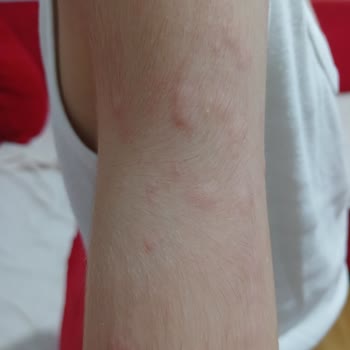 Duru Sabun Duru Marka Alerji Yaptı Cilt Döküntüsü Yaptı